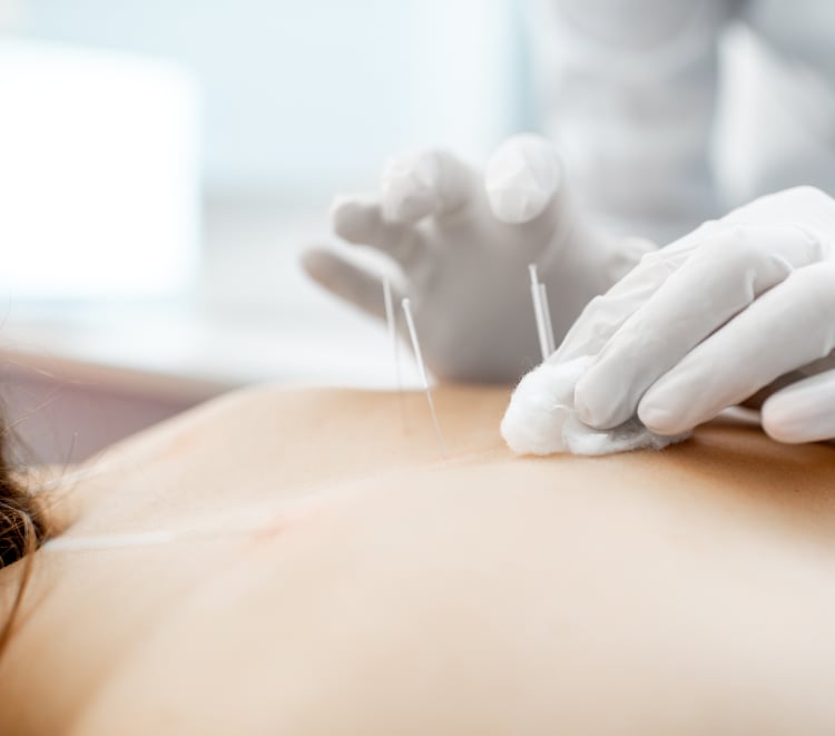 Acupuncture - All Care Family Chiropractic & Massage